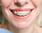 Ghidul pacientului cu aparat dentar: la ce să te aștepți în timpul tratamentului ortodontic